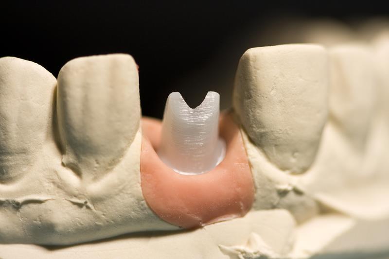 Implant Restoration Titusville, FL