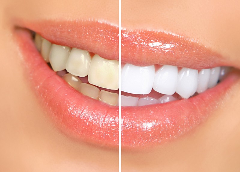 Teeth Whitening Titusville, FL