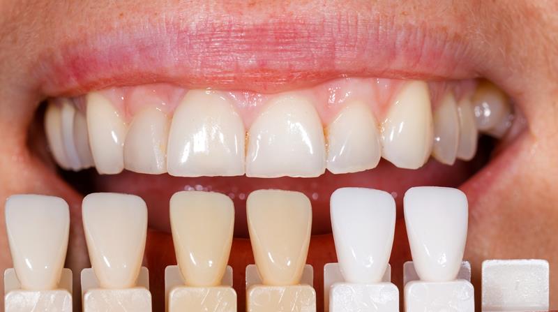 Veneers Titusville, FL